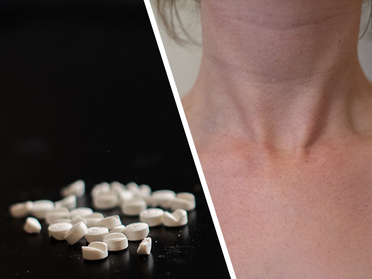 Levaxin är standardbehandlingen vid underfunktion i sköldkörteln. Under 2018 behandlades nära en halv miljon för hypotyreos.